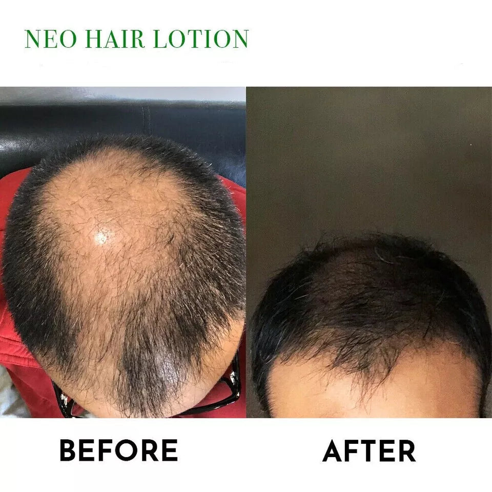 NEO Hair Regrowth Lotion | Hair Loss, Thinning & Baldness Treatment Hair Oil
