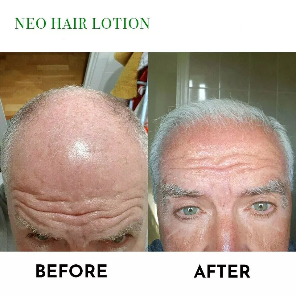 NEO Hair Regrowth Lotion | Hair Loss, Thinning & Baldness Treatment Hair Oil