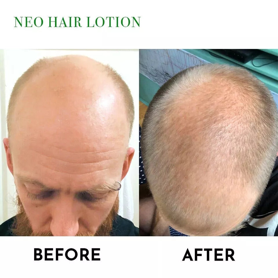 NEO Hair Regrowth Lotion | Hair Loss, Thinning & Baldness Treatment Hair Oil