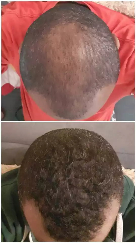 NEO Hair Regrowth Lotion | Hair Loss, Thinning & Baldness Treatment Hair Oil