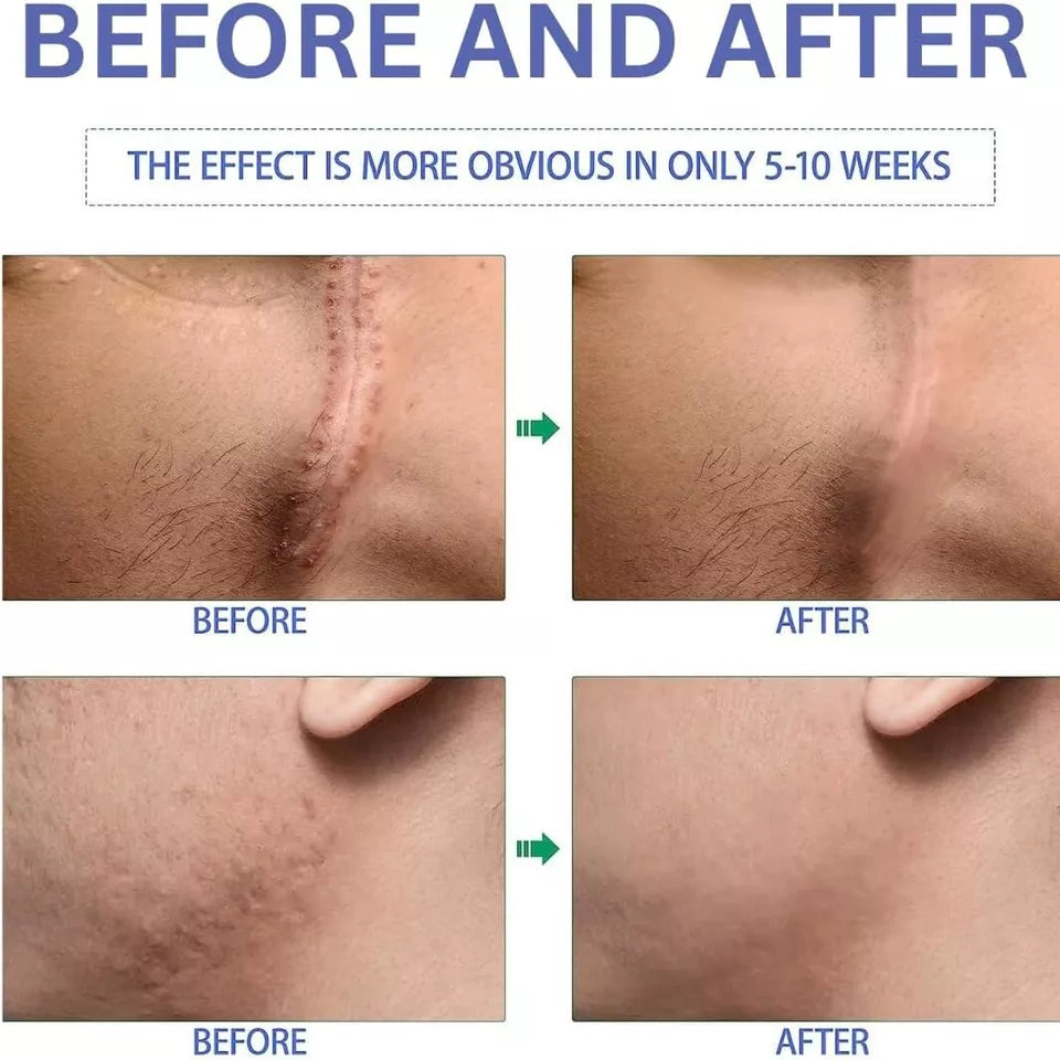 Silicone Scar Gel β Stretch Marks & Surgery Scar Removal Cream | Advanced Skin Care Treatment